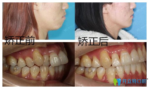 青島維樂口腔齙牙矯正<span style=