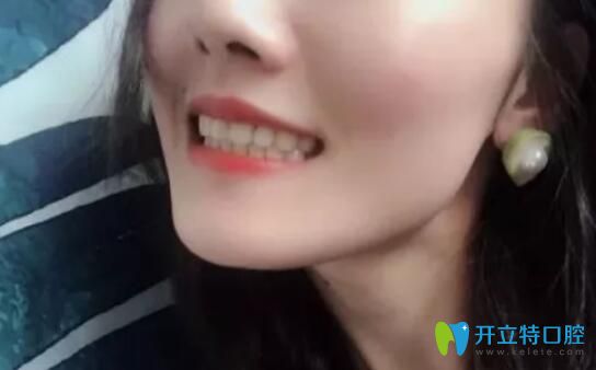 一年半下牙套戴保持器照片
