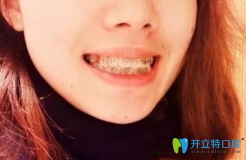 泗洪眾迪口腔戴牙套第2天