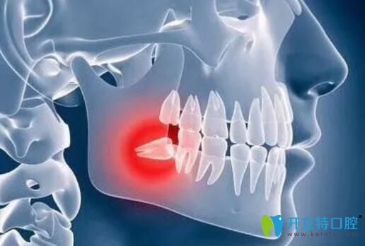 拔智齒的收費(fèi)差別