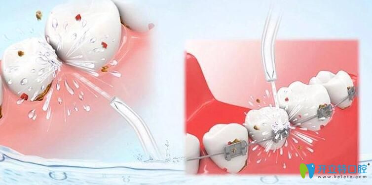 牙齦萎縮如何矯正