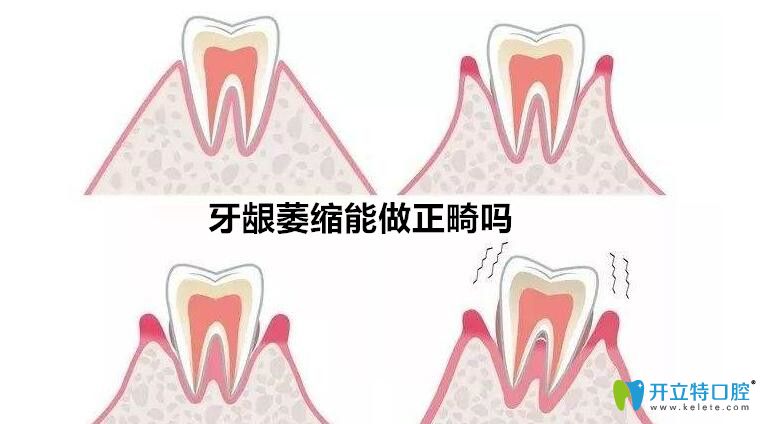 牙齦萎縮能矯正牙么？聽(tīng)泗洪口腔正畸醫(yī)生解說(shuō)