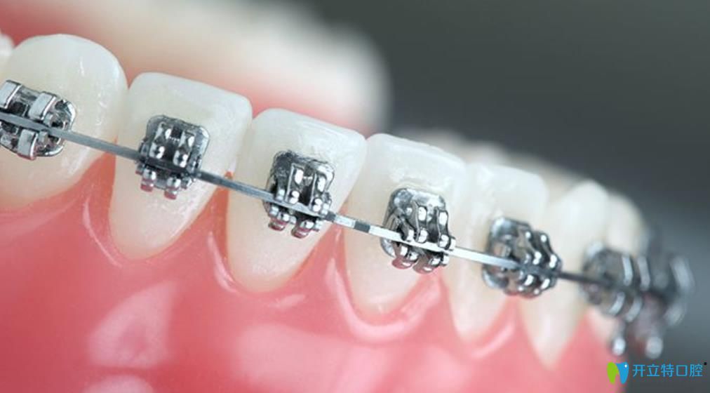 王曉涵醫(yī)生告訴大家：26歲有沒有必要矯正牙齒