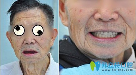 在天津中諾做過(guò)立得用全口種植牙對(duì)比效果