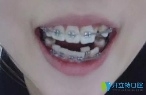 我在合肥崔勁松口腔做牙齒矯正第4個月