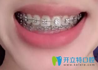 我在合肥崔勁松口腔做金屬托槽牙齒矯正13個月