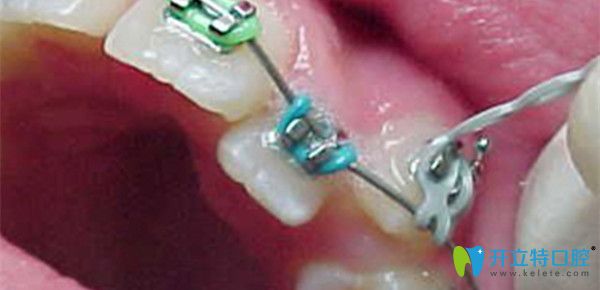 矯正中收縫的過程