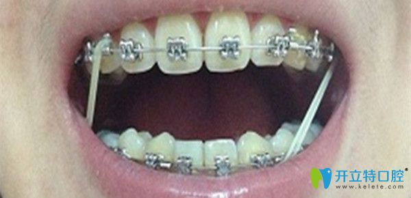 牙齒矯正中收縫要多久