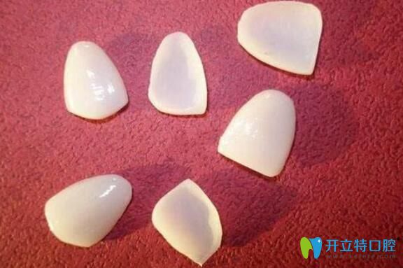 劉金芳醫(yī)生給大家科普：瓷貼面壞了以后該怎么修復(fù)