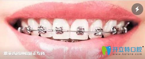 選擇杭州雅萊口腔做牙齒矯正的理由