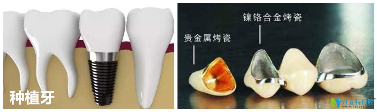 <!--<i data=20240703-sp></i>-->口腔王懷元醫(yī)生科普：種植牙和烤瓷牙有什么區(qū)別