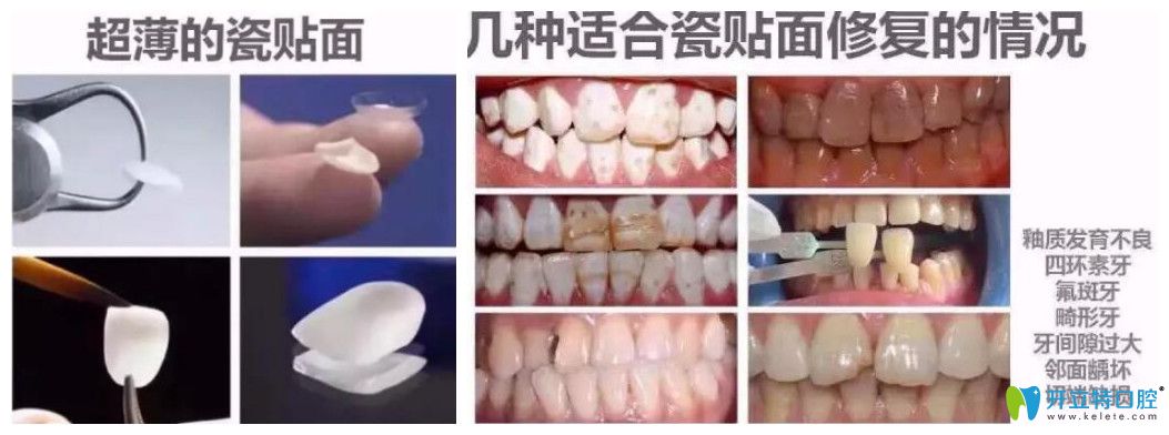 太原華美口腔特色項目瓷貼面