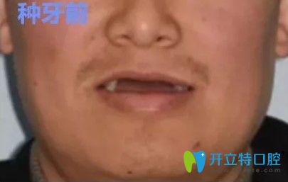 張先生做過(guò)全口種植牙后的照片