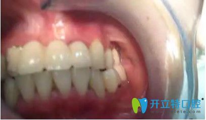劉女士做完全口種植牙后的效果