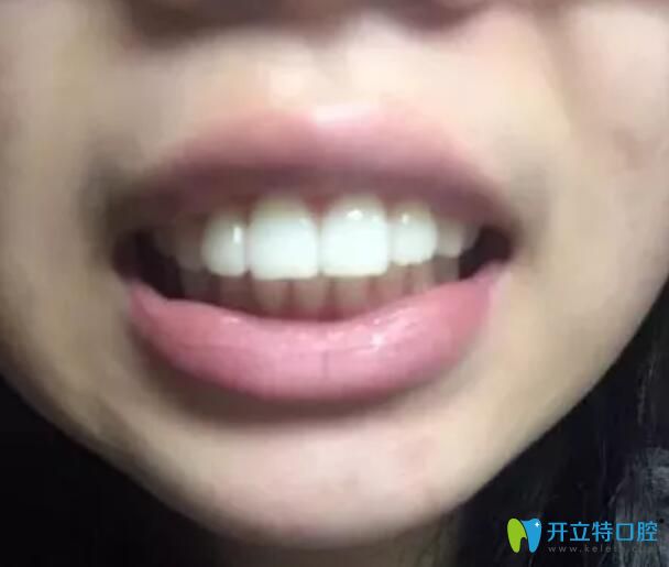 骨性+牙性齙牙在太原華美矯做了金屬鋼絲矯正，現(xiàn)下牙套了