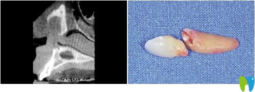 談下我做瑞士iti親水種植牙的經(jīng)歷及1年后的感受 價格心疼..