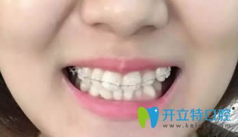 在連江縣明輝口腔做的陶瓷矯正歷經(jīng)18個(gè)月終于要下牙套了！