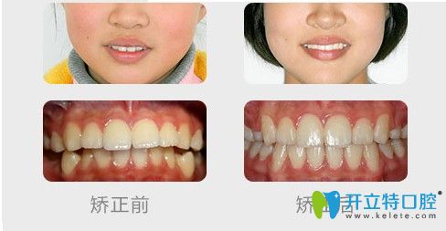 成人深覆蓋矯正案例效果對(duì)比照