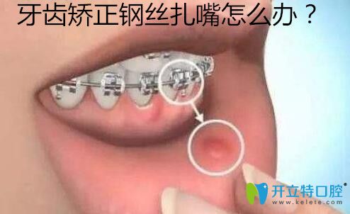 金屬托槽牙齒矯正鋼絲扎嘴磨嘴怎么辦？