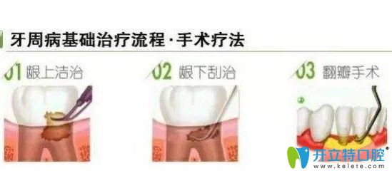 牙周病治療方法