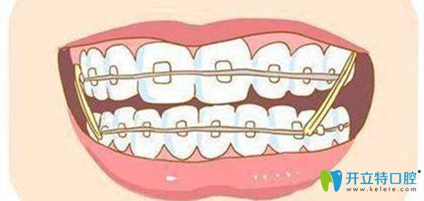 牙齒矯正時間的長短與那些因素有關(guān)