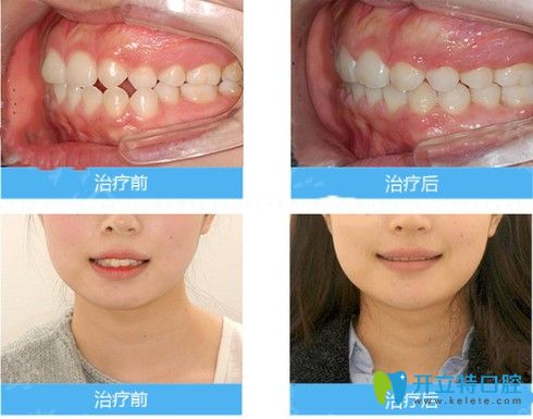 中山美南華牙科中心對刃頜矯正效果圖
