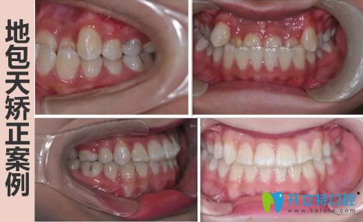 中山美南華地包天牙齒矯正前后對比照