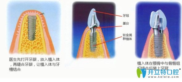 中山美南華牙科主任江會(huì)昇解說種植牙術(shù)后注意事項(xiàng) 中山美南華牙科主任江會(huì)昇解說種植牙術(shù)后注意事項(xiàng)