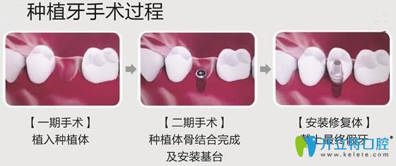 泉州維樂(lè)口腔徐震武醫(yī)生介紹種植牙過(guò)程