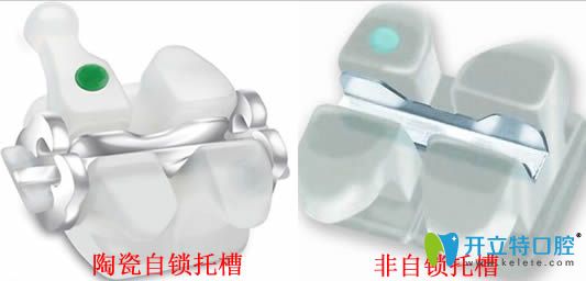 陶瓷牙套太厚是其劣勢(shì)但不是容易掉的原因