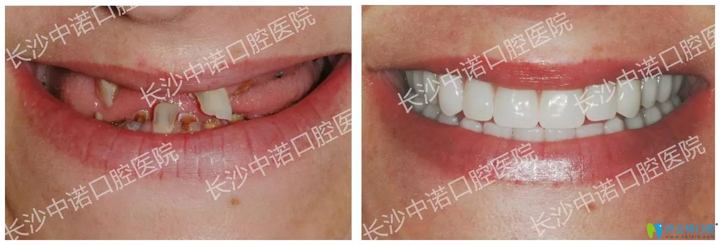 長沙中諾口腔立得用種植牙效果