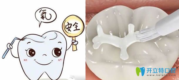 兒童防齲齒-做了窩溝封閉后還需要做涂氟嗎？能同時(shí)做嗎?