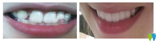 長(zhǎng)沙中諾口腔隱形矯正案例