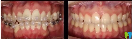 長(zhǎng)沙中諾半隱形案例