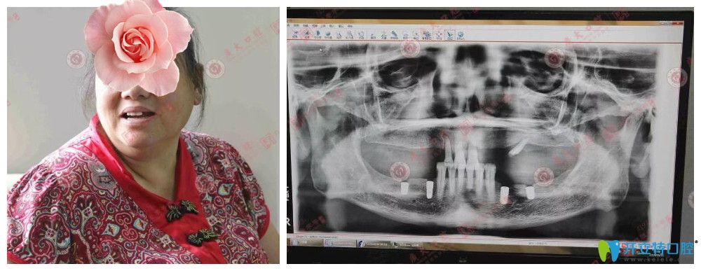 廣州種植牙醫(yī)院哪家好？廣大口腔顧客種植牙真人案例來驗(yàn)證
