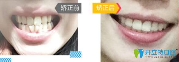 廣州哪里做牙齒正畸好？來看廣大口腔牙齒矯正前后對(duì)比圖