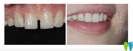 正夫口腔矯正牙縫大效果圖