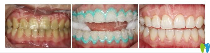 正夫口腔激光牙齒美白案例