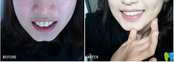 團(tuán)圓口腔矯正案例對比圖