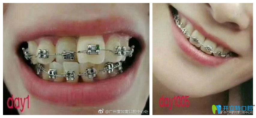 牙齒擁擠不齊，個(gè)別反頜小姐姐也來打卡啦