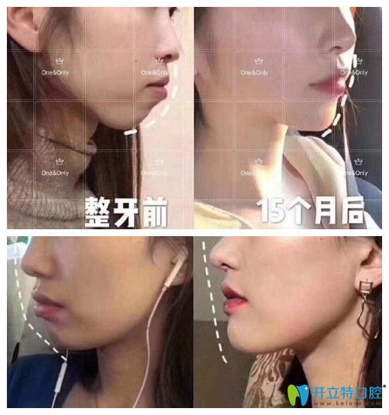 廣州壹加壹矯正牙齒好嗎？小姐姐在壹加正畸打卡記錄公開