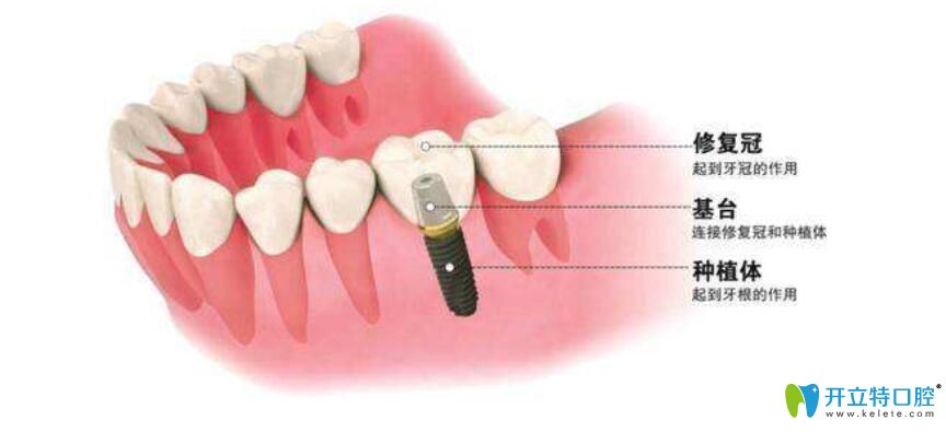 了解種牙牙冠價(jià)格前，先弄清楚種植牙牙冠有哪些種類