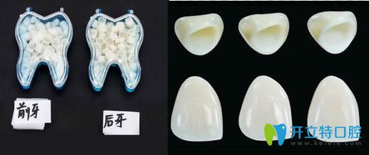 磨完牙要戴的臨時牙冠圖