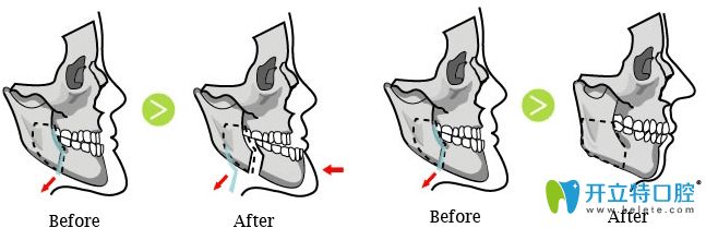 廣州廣大口腔地包天矯正變化圖