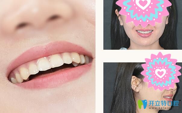 格倫菲爾口腔牙齒前突矯正案例前后效果對比