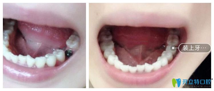 成都圣貝牙科即刻種植牙案例