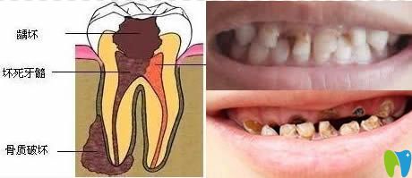 兒童乳牙齲壞真實(shí)寫照