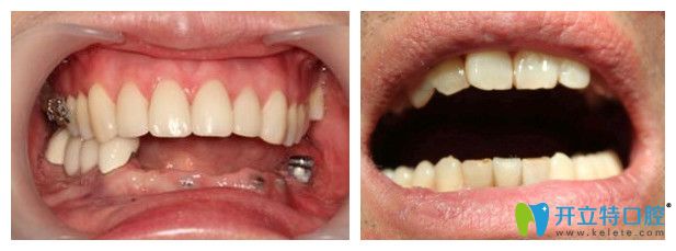 沈陽(yáng)百嘉麗口腔種植牙案例