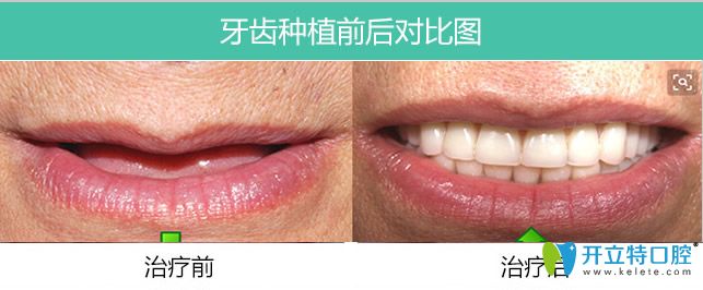 長(zhǎng)春牙博士口腔全口allon4種植牙案例