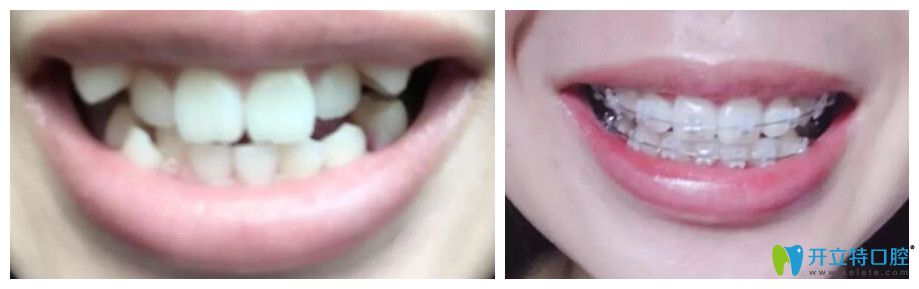 沈陽(yáng)百嘉麗口腔牙齒矯正對(duì)比圖